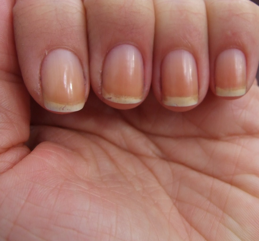 finger nail problems